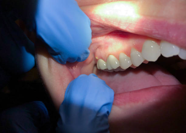 Best Cracked Tooth Emergency Dentist  in Fort Stewart, GA